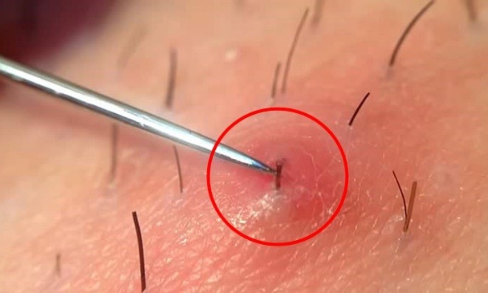 urasla dlaka nakon depilacije